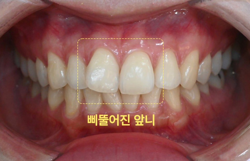 메타치과의원 앞니 부분교정 상담 안내 이미지