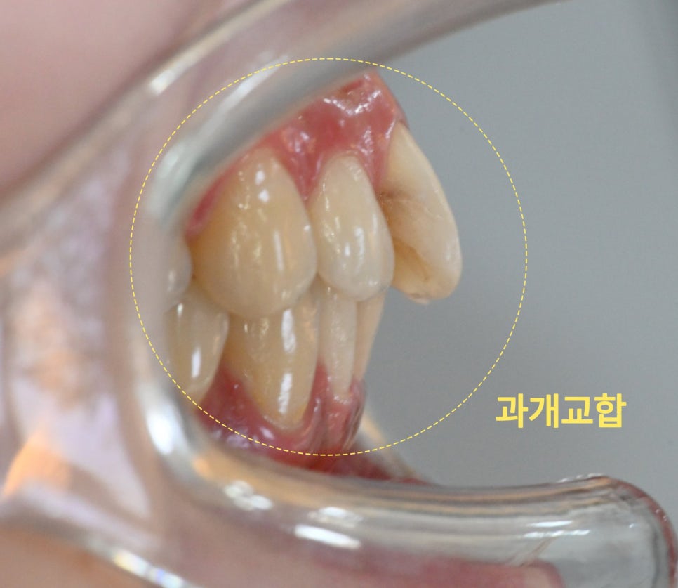 앞니 부분교정 초기 진단 시 치아 배열 확인
