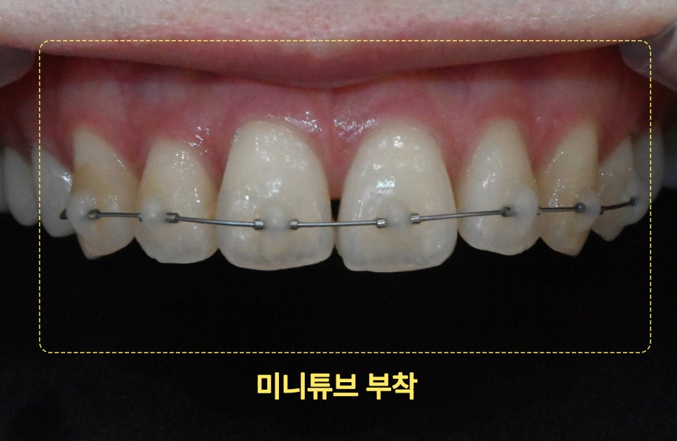 앞니 부분교정 장치 부착 후 구강 상태