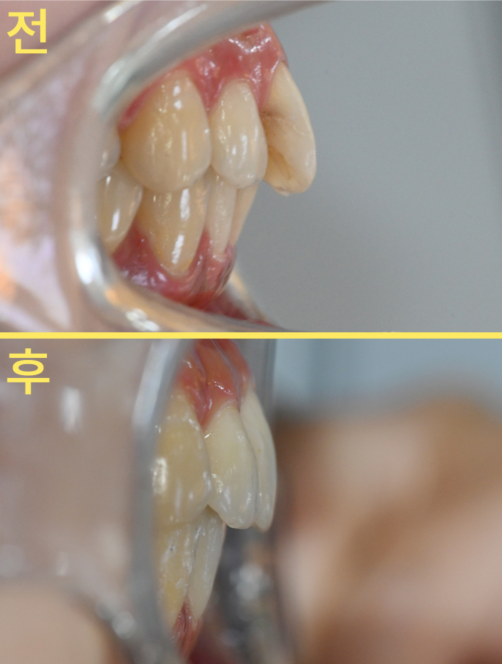 메타치과의원 앞니 부분교정 의료진 진료 모습