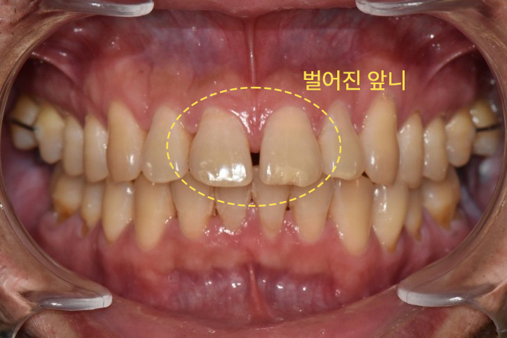 벌어진앞니 교정 상담을 위한 메타치과의원 진료실
