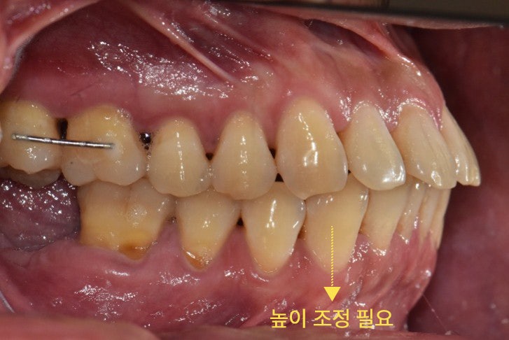 벌어진앞니 교정 진단을 위한 파노라마 방사선 검사
