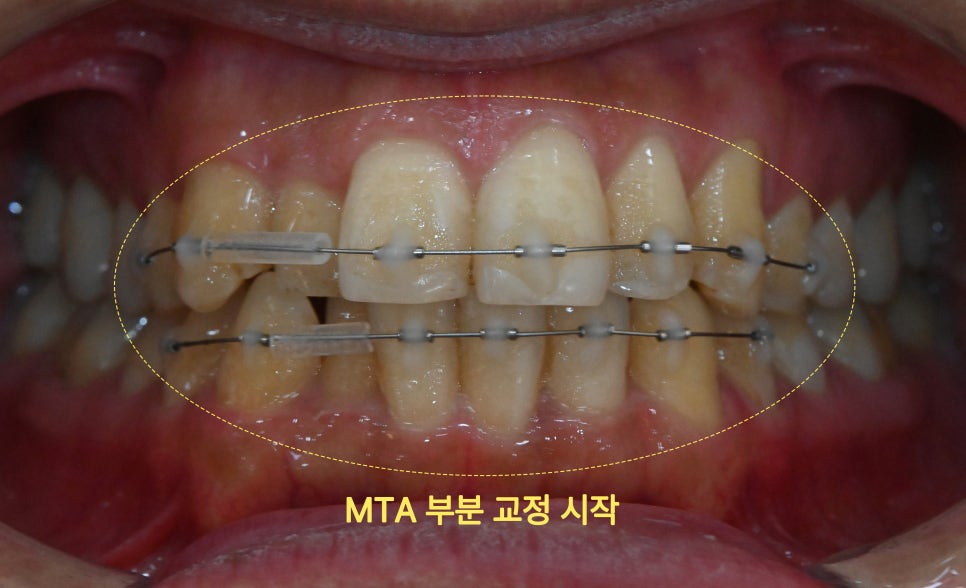 앞니부분교정 25년 9월 26일 경과 이미지