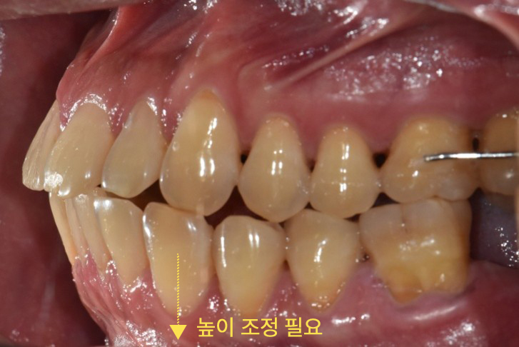 벌어진앞니 교정 전 앞니 사이 공간 확인