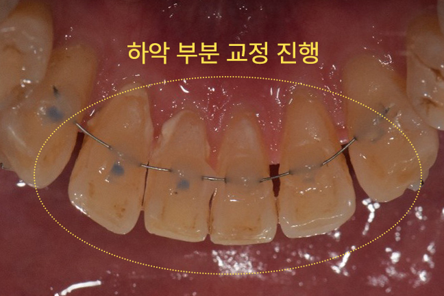벌어진앞니 교정 중기 진행 경과 확인