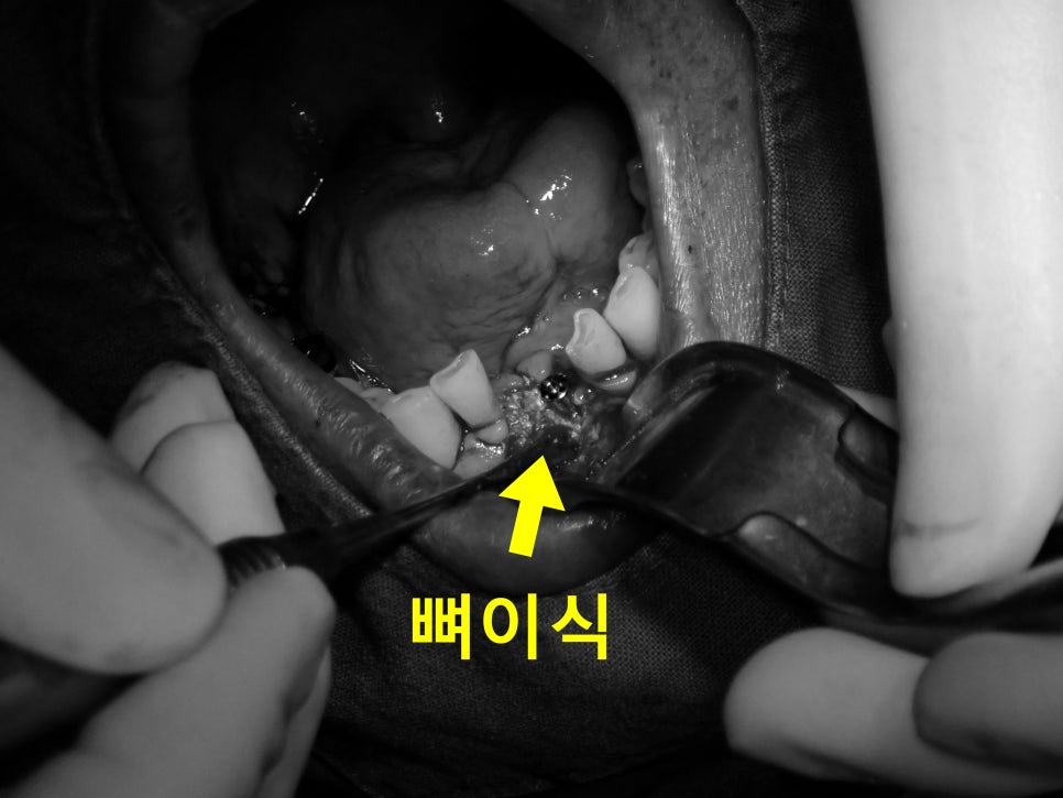 소래포구역치과 충치 치료 과정 설명 이미지